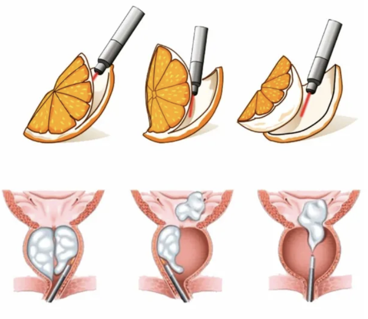 HoLEP (Enucleação da Próstata com Holmium Laser)